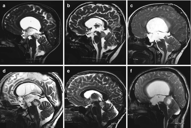 中<a href='/qianyan/naozhongliu/' target='_blank'><u>腦腫瘤</u></a>的手術(shù)入路解讀