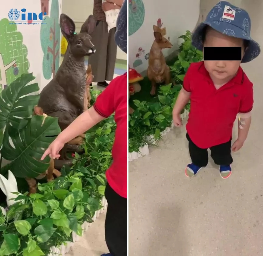 寶寶下丘腦膠質瘤可以手術嗎