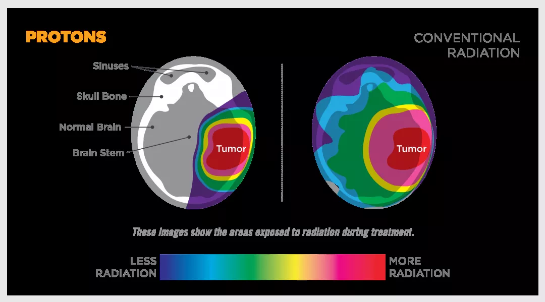 質(zhì)子治療為23歲患有腦腫瘤的繪畫師帶來希望
