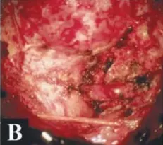 枕骨大孔腦膜瘤 圖片1