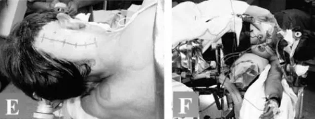 枕骨大孔腦膜瘤手術(shù)圖片