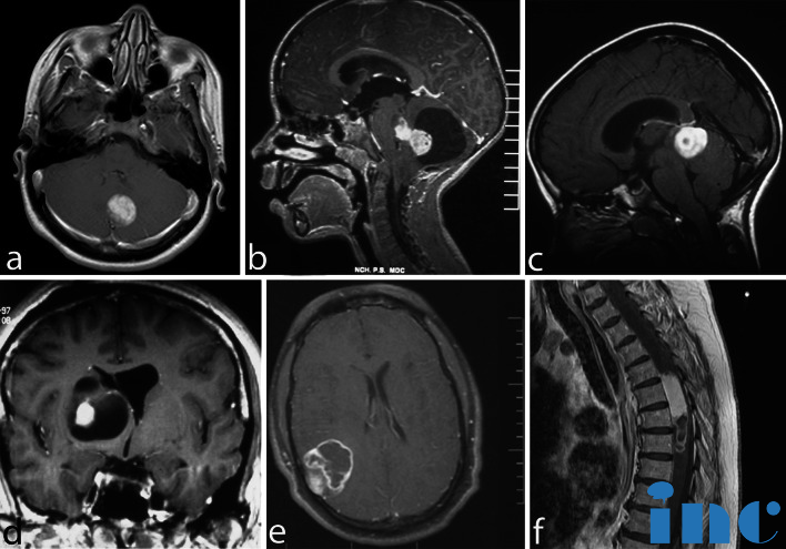 一級膠質(zhì)瘤能治好嗎？毛細(xì)胞型星形細(xì)胞瘤可痊愈