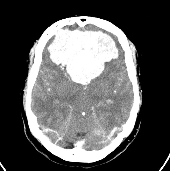 額葉腦膜瘤有哪些癥狀？怎么治？