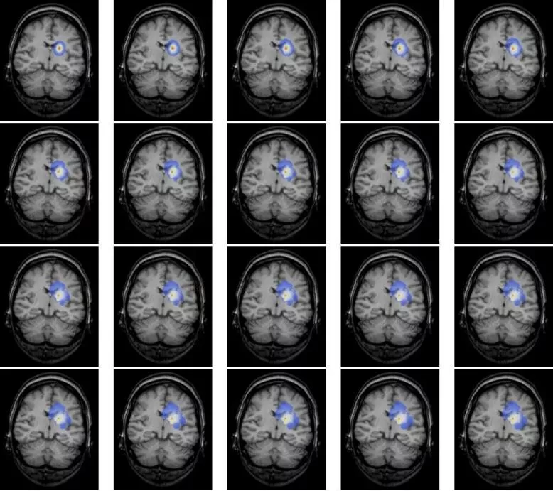 低級(jí)別膠質(zhì)瘤嚴(yán)重嗎，手術(shù)還是等等看？