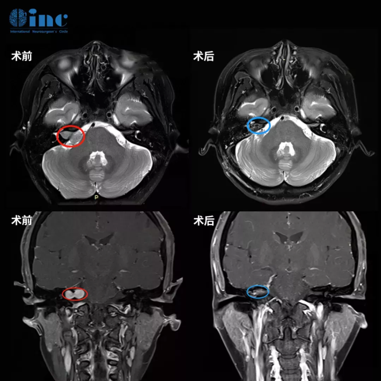 腦干腫瘤、視神經(jīng)膠質(zhì)瘤等如何找到治療新希望？| INC國(guó)際神外專家遠(yuǎn)程咨詢實(shí)錄