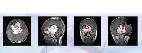 視神經(jīng)膠質(zhì)瘤術(shù)前