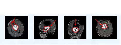 視神經(jīng)膠質(zhì)瘤手術(shù)圖片