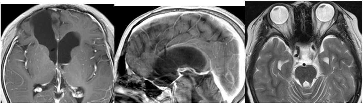 視神經(jīng)膠質(zhì)瘤早期癥狀