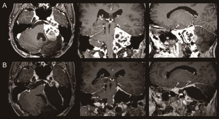 復(fù)發(fā)性較大聽神經(jīng)瘤手術(shù)全切案例：術(shù)后患者平衡和顱神經(jīng)功能完全恢復(fù)