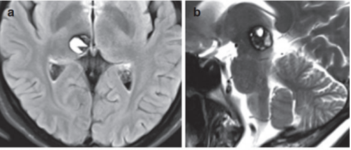 出血性腦海綿狀血管瘤嚴重嗎？3次突發(fā)左手和左側(cè)面部暫時性感覺障礙