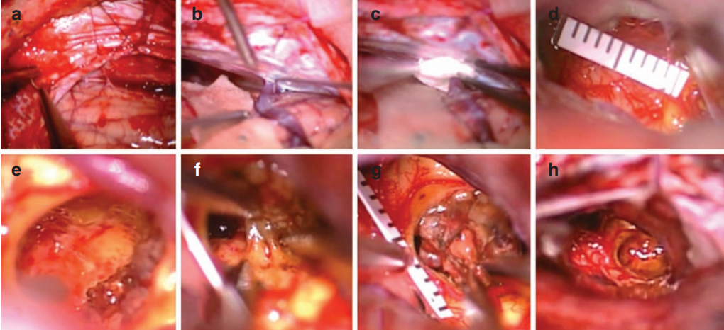 腦海綿狀血管瘤嚴(yán)重嗎？