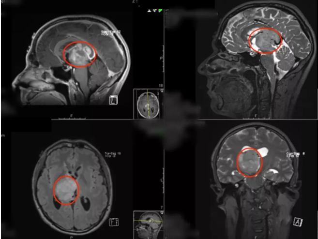 丘腦膠質(zhì)瘤可以順利手術(shù)嗎？