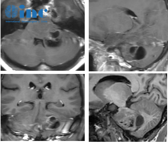 彌漫性膠質(zhì)瘤是良性還是惡性