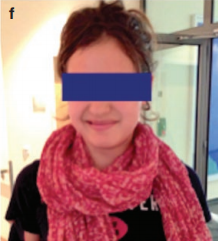 14歲女孩突發(fā)癲癇，松果體區(qū)海綿狀血管瘤術(shù)后重拾笑容