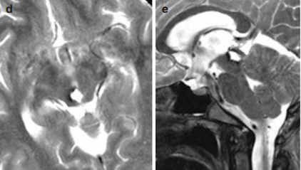 松果體區(qū)海綿狀血管瘤治療