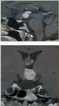 高難度視神經(jīng)-下丘腦膠質(zhì)瘤導(dǎo)致閉經(jīng)、威脅視力，翼點入路順利全切腫瘤手術(shù)圖解