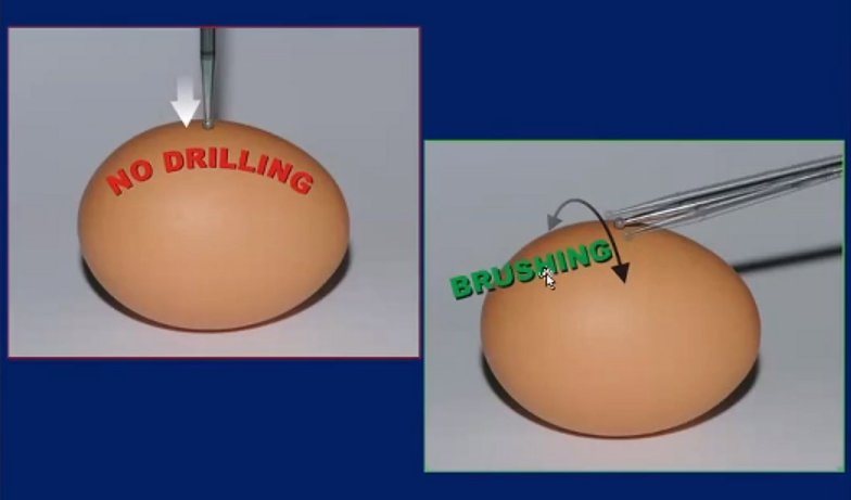 腫瘤長(zhǎng)在海綿竇區(qū)能做手術(shù)嗎？Dolenc入路創(chuàng)始者、海綿竇手術(shù)開(kāi)拓者海綿竇腦膜瘤成功案例解讀