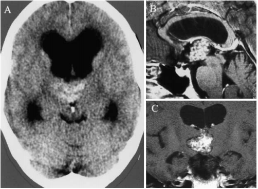 雙側(cè)丘腦海綿狀血管瘤可以手術(shù)嗎？INC德國巴特朗菲教授早期手術(shù)案例一則