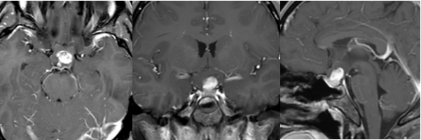視神經(jīng)膠質(zhì)瘤赴德全切術(shù)后1年回訪：視交叉-下丘