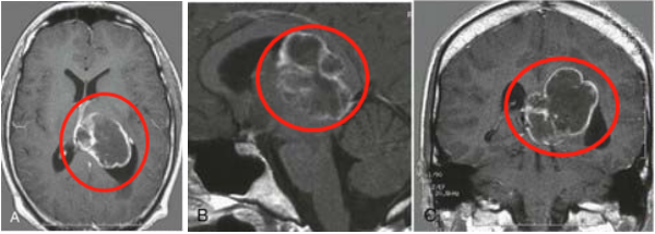 職業(yè)運動員較大腦室內(nèi)腫瘤，赴德順利全切腫瘤后欲重返賽場！