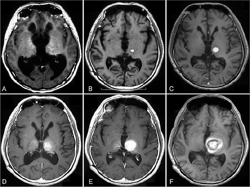 丘腦海綿狀血管瘤出血幾率大嗎？如何應(yīng)對？