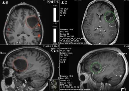 島葉膠質(zhì)瘤嚴(yán)重嗎？怎么治療？島葉膠質(zhì)瘤治療成功案例交流