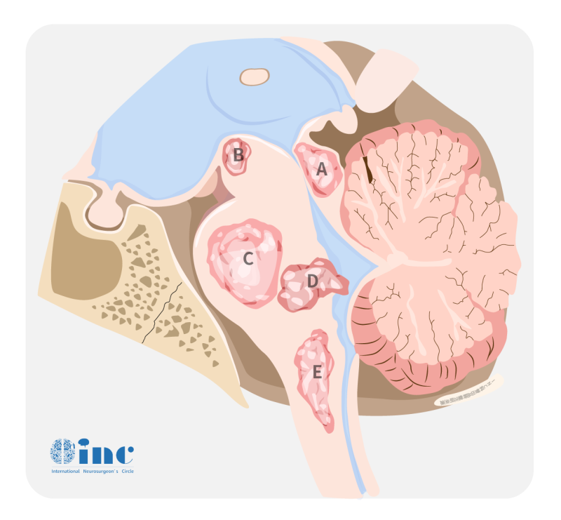 膠質(zhì)瘤死前一周癥狀是什么？