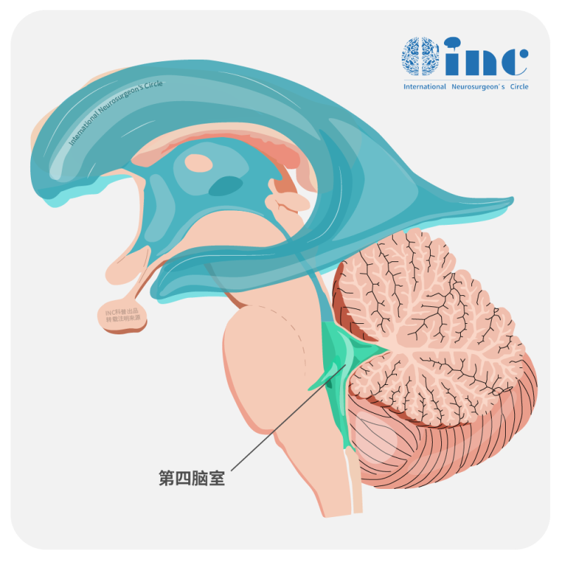 四腦室室管膜瘤是惡性嗎？怎么治？