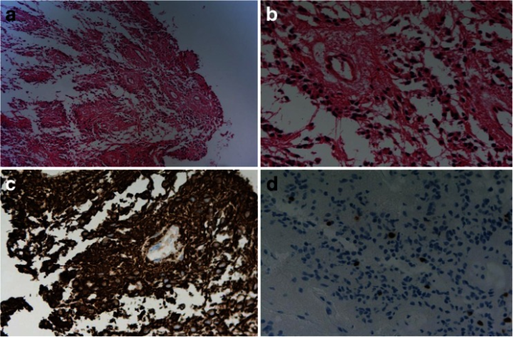 后顱窩腫瘤可以治愈嗎？圖片2