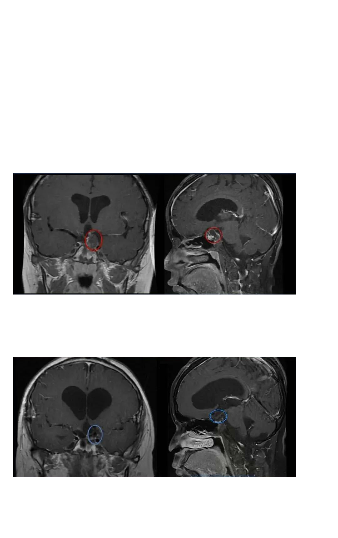 顱咽管瘤易復(fù)發(fā)嗎？難手術(shù)？未全切后的治療之路漫長曲折還有救嗎？