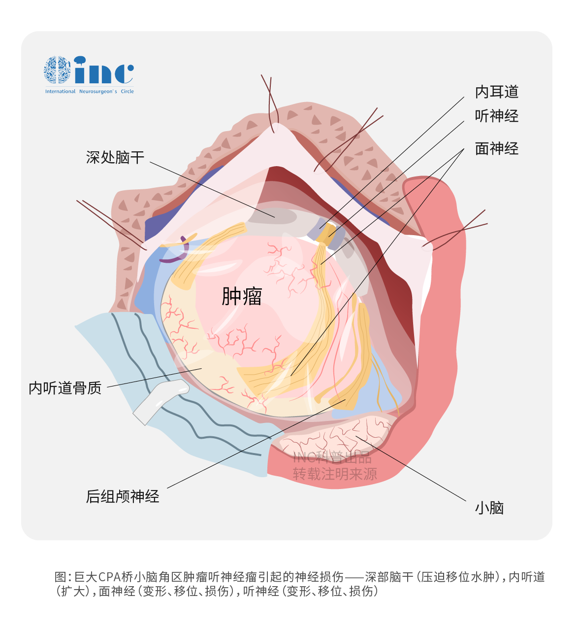 CPA橋小腦區(qū)腫瘤手術(shù)難度大嗎？CPA區(qū)橋小腦角區(qū)腦膜瘤手術(shù)成功案例