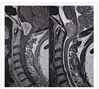 55歲枕骨大孔腦膜瘤全切案例