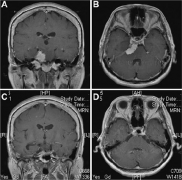 INC國(guó)際教授Kawase入路創(chuàng)始人切除巖斜腦膜瘤案例交流
