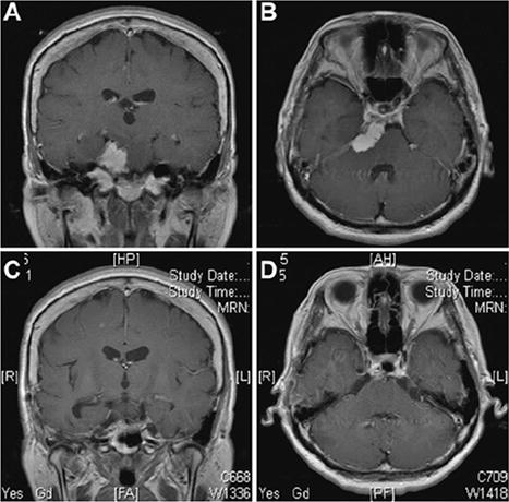 巖斜區(qū)腦膜瘤手術(shù)——Kawase入路手術(shù)