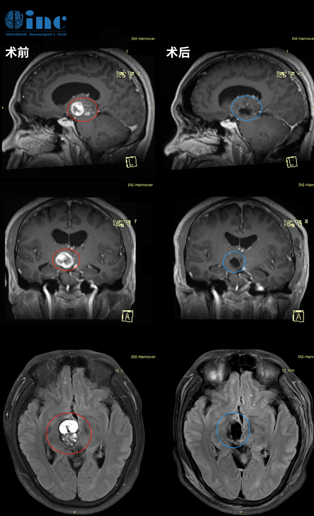 INC老患者自述腦瘤手術(shù)經(jīng)歷，赴德手術(shù)，都是值得的！