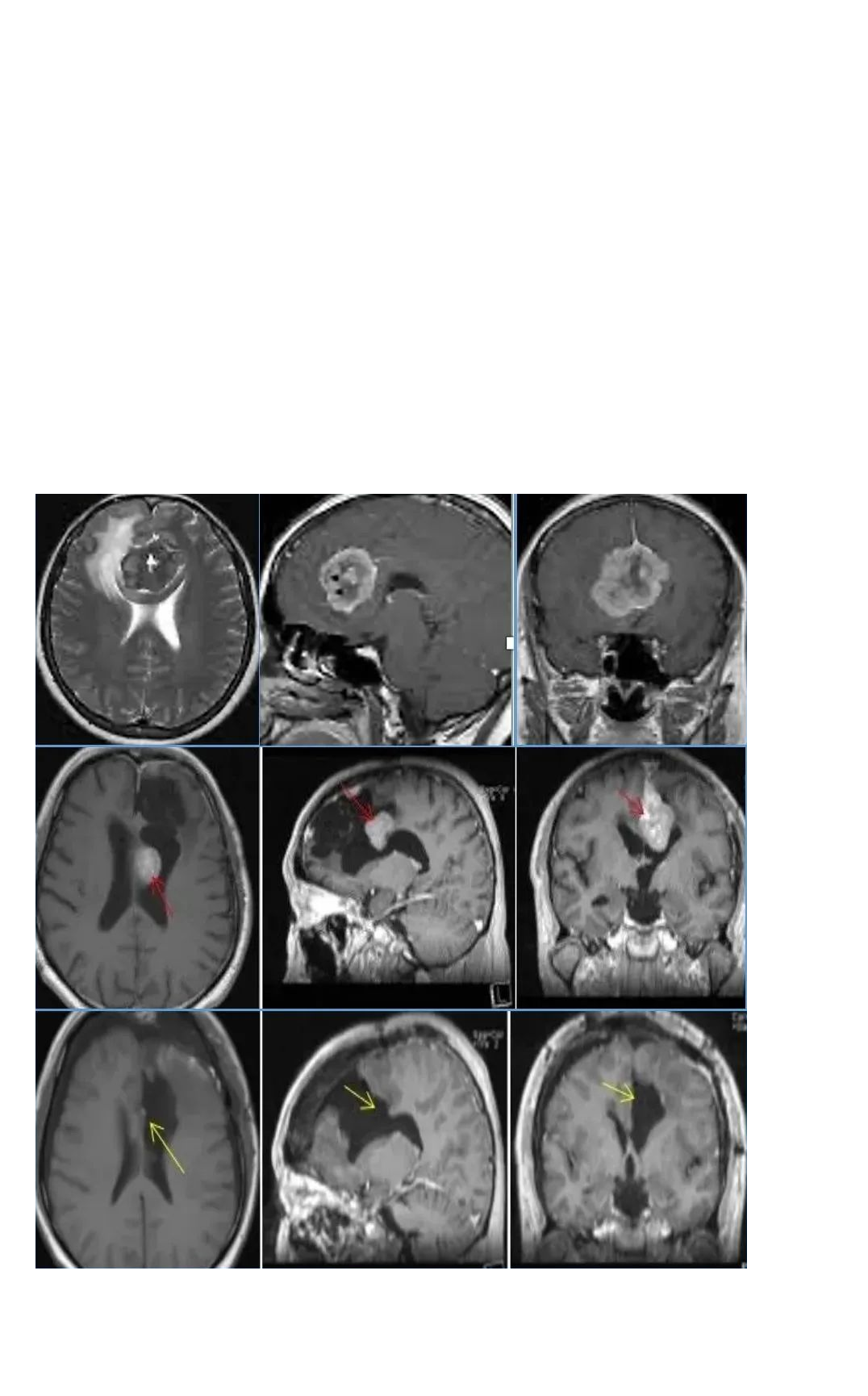 腦膜瘤優(yōu)選放療還是手術(shù)？