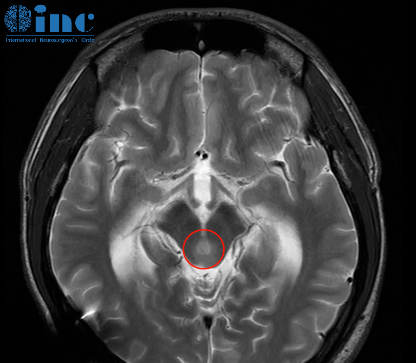 腦干膠質(zhì)瘤2月快速增大，術(shù)后即清醒、無癱瘓，INC國際教授如何一刀挽救21歲研究生？