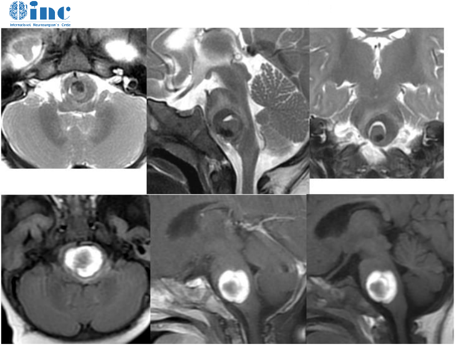【INC巴教授咨詢實例】發(fā)現(xiàn)了腦干海綿狀血管瘤就要手術嗎？