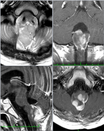 腦干延髓節(jié)細(xì)胞膠質(zhì)瘤首刀后狀態(tài)不佳，還有二次手術(shù)機(jī)會(huì)嗎？