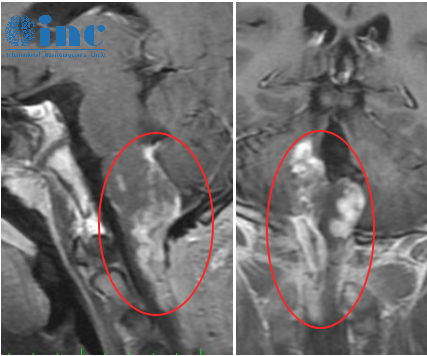 廣泛巨大腦干膠質瘤險致癱瘓，術后7天自如行走、解除致命危機