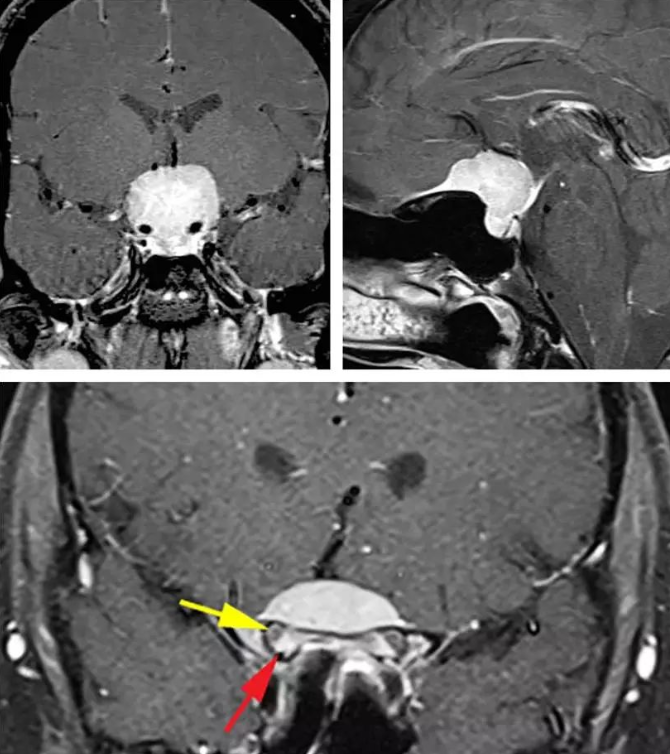鞍結(jié)節(jié)腦膜瘤內(nèi)鏡還是開顱？