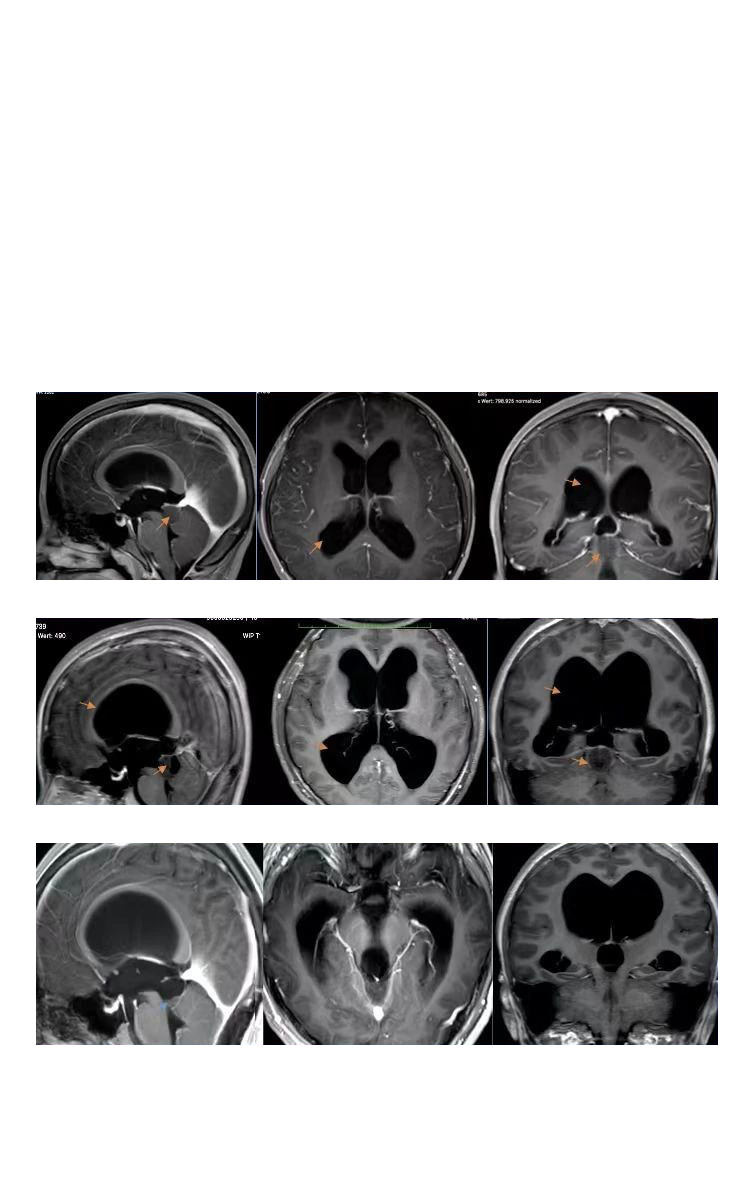 膠質(zhì)瘤手術(shù)可以等嗎？