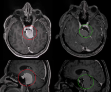 國(guó)際顱底手術(shù)教授INC法國(guó)Froelich教授大型巖斜區(qū)腦膜瘤手術(shù)圖解紀(jì)實(shí)