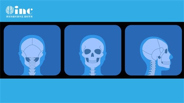 腦部左頂葉海綿狀血管瘤（癥狀、病因和治療）