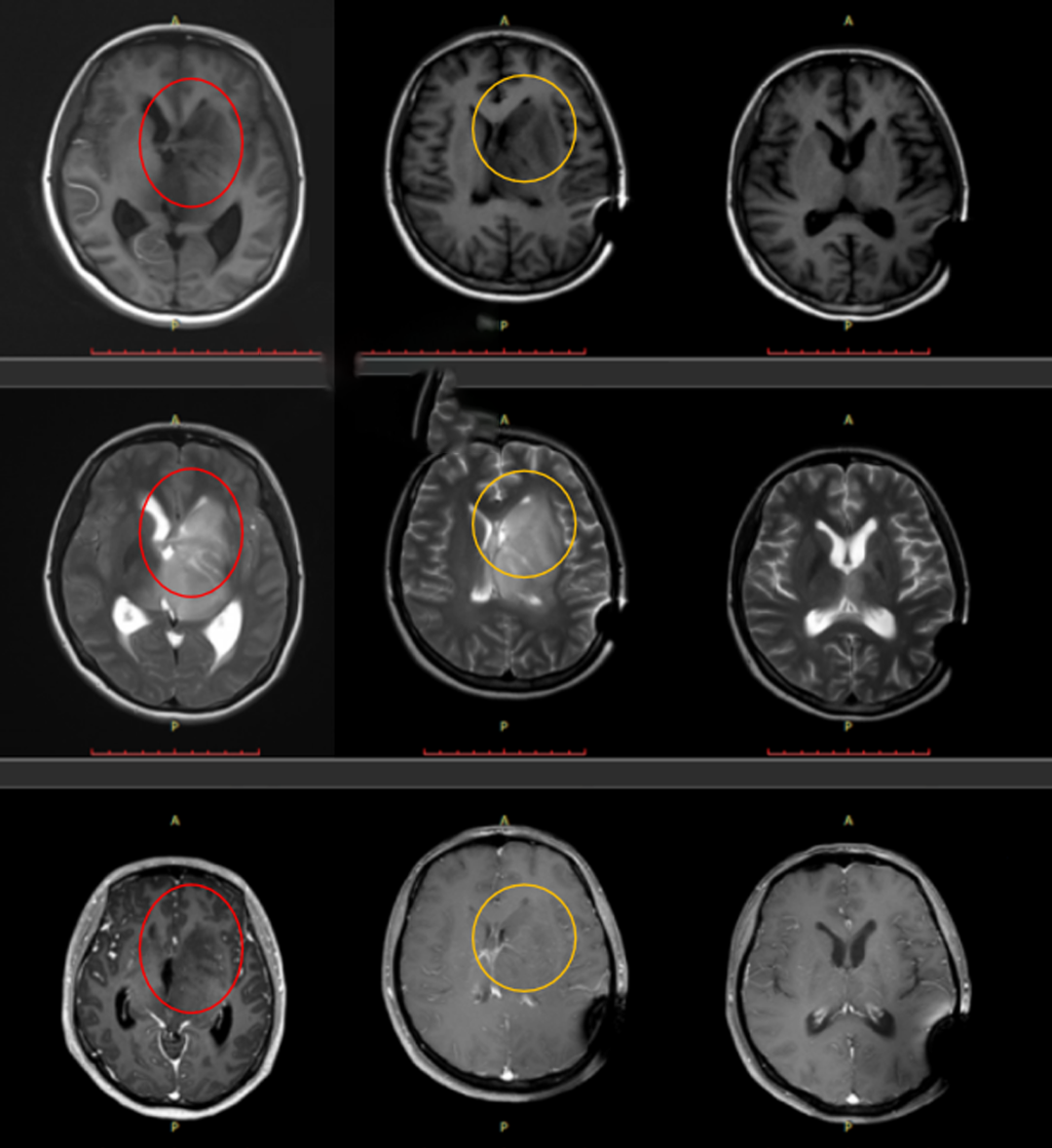 丘腦膠質(zhì)瘤怎么治療？INC巴特朗菲教授手術案例交流