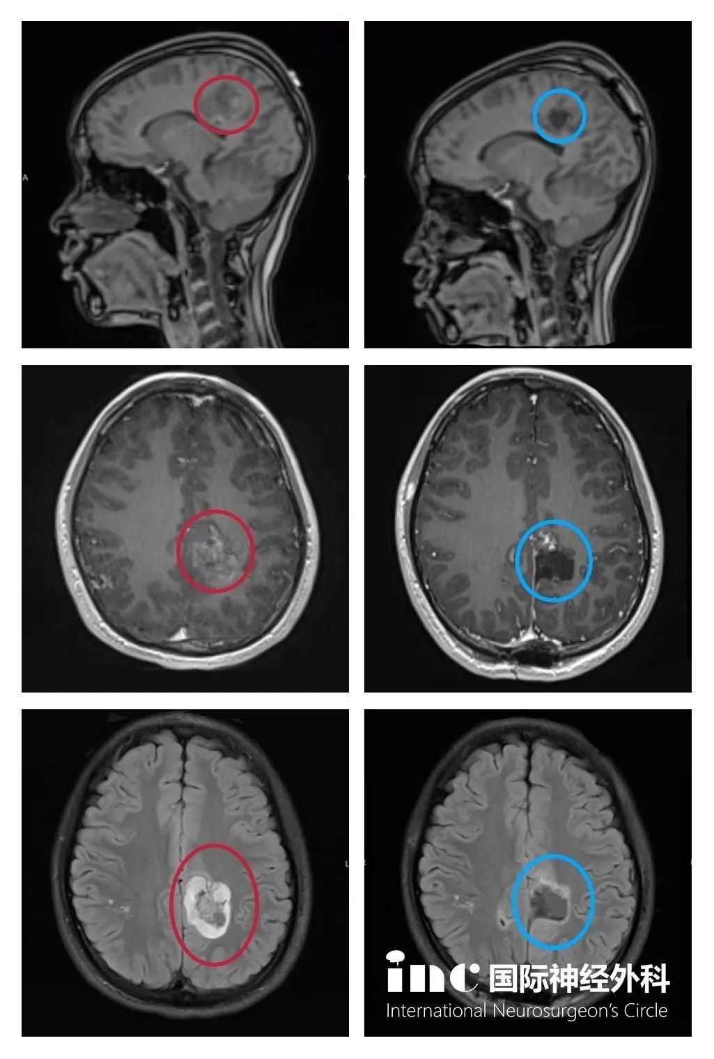 功能區(qū)<a href='/bingzhong/jiaozhiliu/' target='_blank'><u>膠質(zhì)瘤</u></a>術(shù)前術(shù)后影像對(duì)比