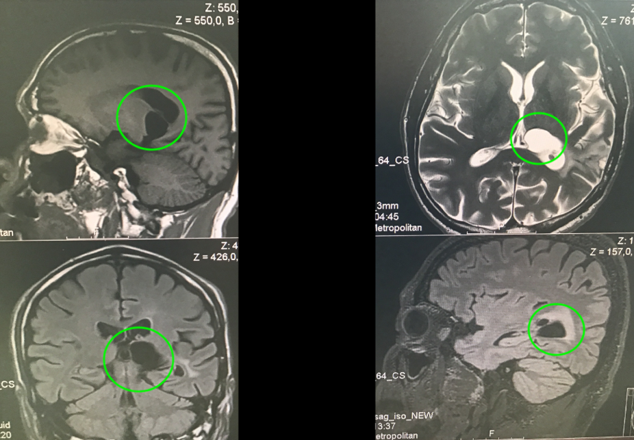丘腦膠質(zhì)瘤術(shù)后