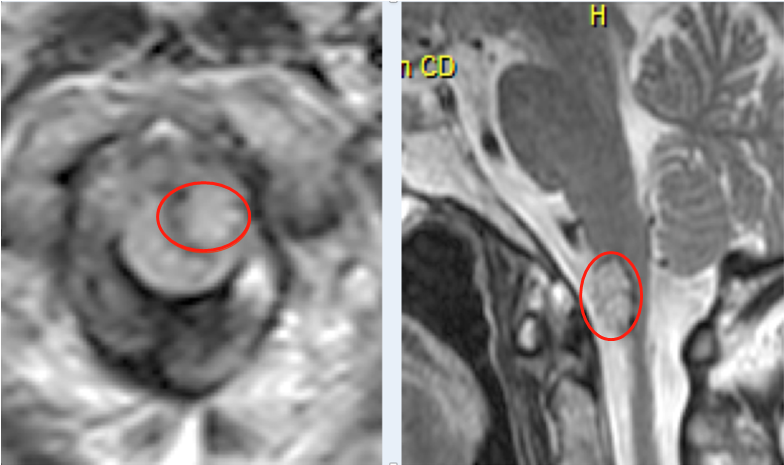 高位頸髓-腦干延髓腦橋海綿狀血管瘤案例：反復腦干出血生命垂危，無助中立遺囑，萬里赴德手術后“重生”