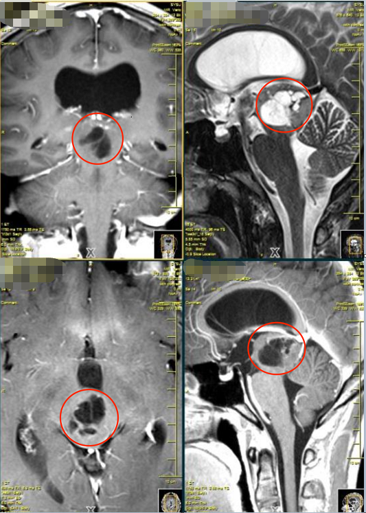 腦干膠質(zhì)瘤12年，求診，終得國際腦瘤專家手術(shù)順利切除