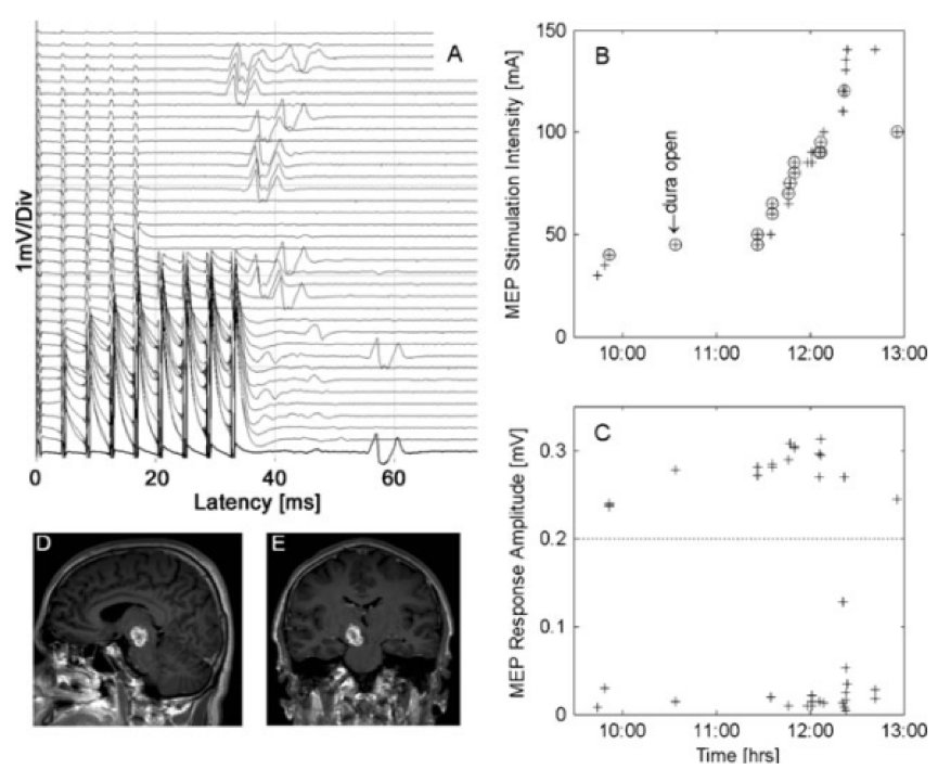 腦干膠質(zhì)瘤